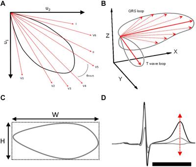 Increased Beat-to-Beat Variability of T-Wave Heterogeneity Measured From Standard 12-Lead Electrocardiogram Is Associated With Sudden Cardiac Death: A Case–Control Study